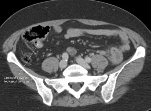 Ct scan anus colon